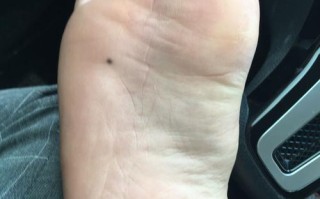 算命脚面上有痦子